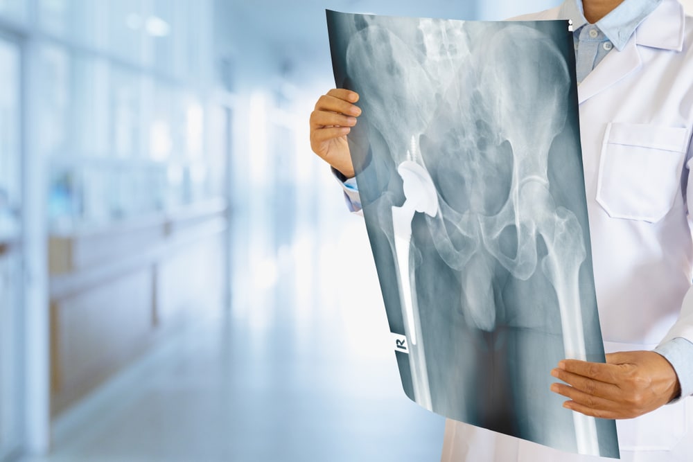 Doctor examining total hip replacement X-ray with blurred hospital background, representing orthopedic evaluation and post-surgical care.
